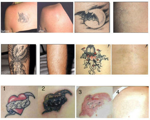 Machine active professionnelle de retrait de tatouage de laser de machine de laser de yag de ND de Q-Commutateur