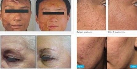 Vertical design Arm laser High Frequency 10600nm Fractional co2 Laser Machine For scar wrinkle Treatment