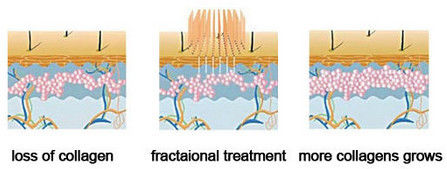10600nm CO2 عمودی دستگاه لیزر فراکشنال برای استفاده دکتر با CO2 لیزر پزشکی T-RC