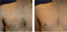 Intense Pulsed Light IPL Hair Removal Machines