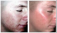 Intense Pulsed Light IPL Hair Removal Machines