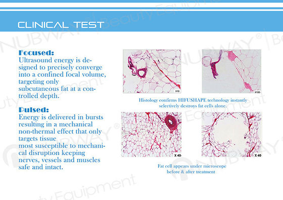 बेस्ट Slimming सौंदर्य उपकरण HIFU उच्च तीव्रता केंद्रित अल्ट्रा HIFU स्लिमिंग