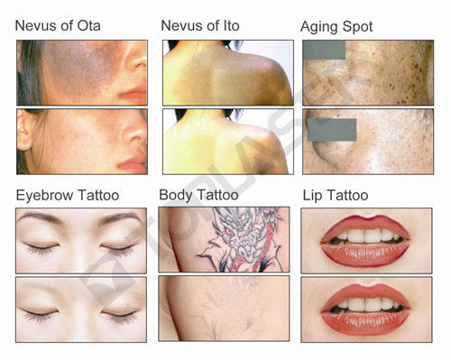 1064nm 10.4Inch TOP HAT Q-switch Nd YAG Laser, 532nm Tattoo Nám diệt