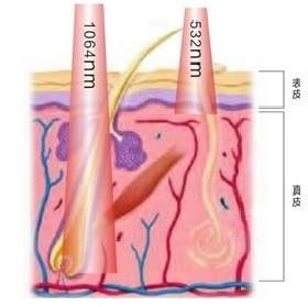 제일 공급자에 의하여 Q 전환되는 ND: Yag 레이저 귀영나팔 제거/피부 회춘 체계