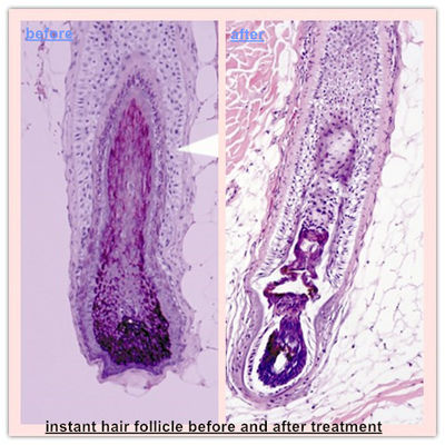 Taşınabilir paralelleştirilmiş 808nm Diod Lazer Epilasyon makinesi Cilt gençleştirme