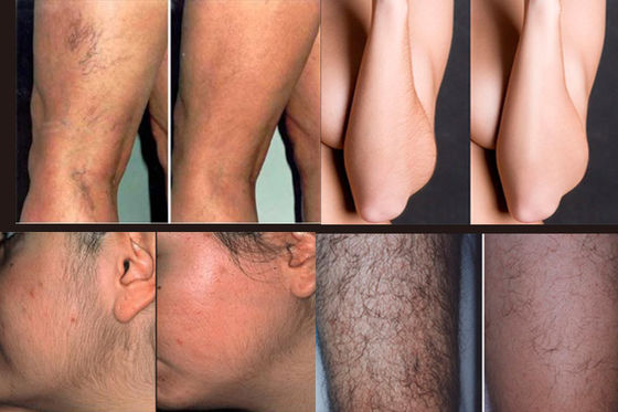 220V উল্লম্ব পেশাগত ডিত্তড লেজার হেয়ার রিমুভাল 808nm হেয়ার রিমুভাল গোল্ড স্ট্যান্ডার্ড