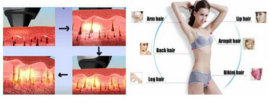 удаление волос лазера диода 808nm/лазера диода/постоянное удаление волос