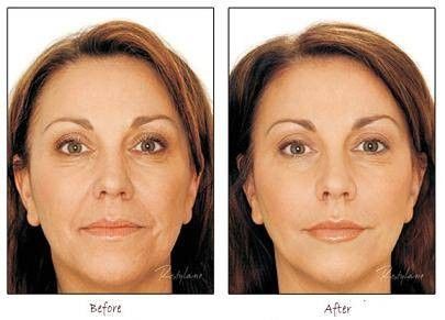 Permanent Wrinkle RF Removal / Remover Beauty Equipment Machine with RF hand Piece