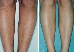 1400W Schönheitssalon verwenden IPL Haarentfernung Hautverjüngung Multifunktionsmaschine