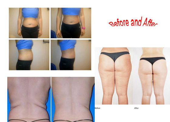 Taşınabilir Çok Fonksiyonlu Lipo Masaj Makinesi, Cryo Fat RF Güzellik Ekipmanları Eritme