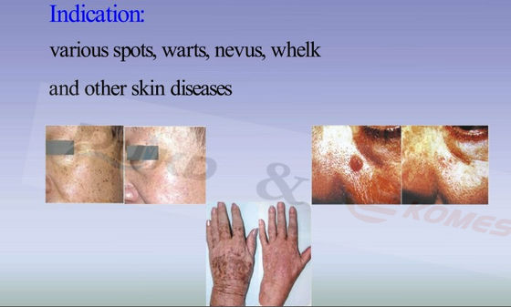 Portable CO2 Water Cooled Laser Fractional Laser Equipment Facial Skin Care 220V